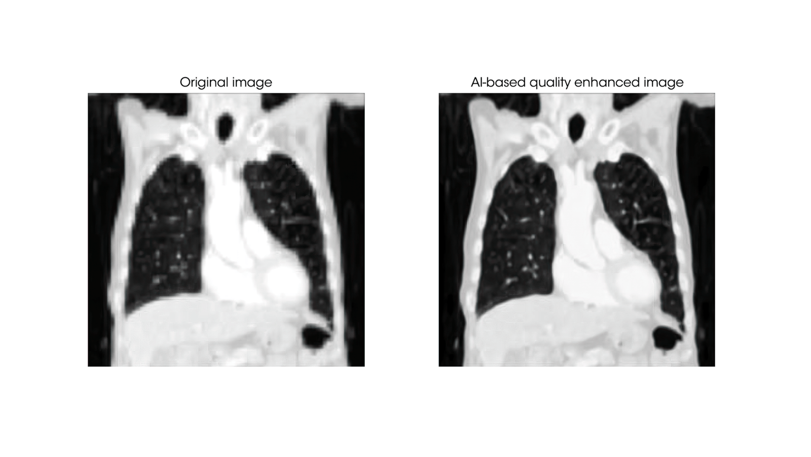 Benefits of AI in radiology