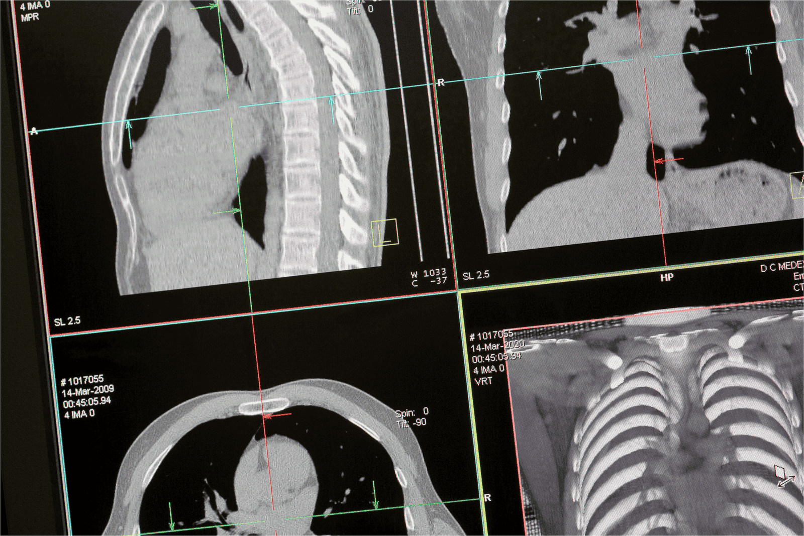 Interpreting mri results