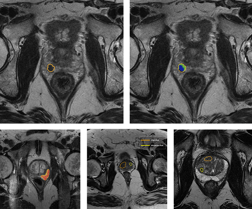 qp-prostate_seg_det_v6-3-2